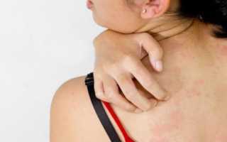 Болит и чешется спина в области лопаток