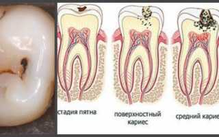 Болит зуб боль отдает в голову
