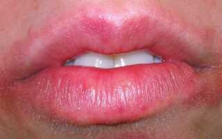 Болит голова и немеют губы что это