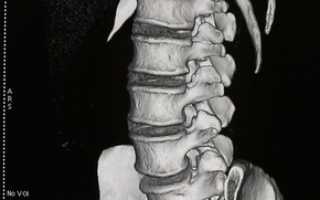 Сколько болит спина после операции на позвоночнике