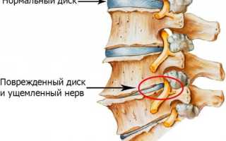 Болит поясница в лежачем положении на спине