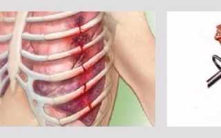 После ушиба грудной клетки болит спина