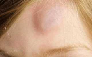 Появилась шишка на голове и болит при нажатии на