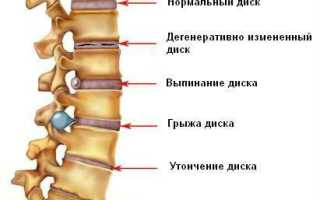 Болит спина печет спина