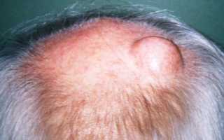 Болела голова и появились по всей голове шишки но голова еще болит