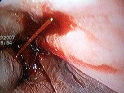 Болит в правой области ребер спины