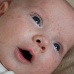 Прыщики на лице и попе у новорожденного