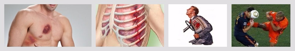 После ушиба грудной клетки болит спина