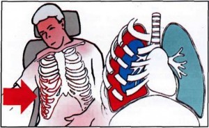 После ушиба грудной клетки болит спина