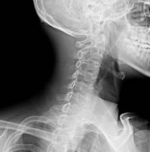 Боль в шее и затылке, голове Боль в шее и затылке