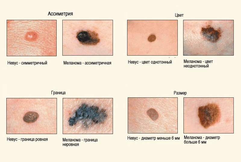 Главные отличия невуса и меланомы