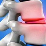 Межпозвоночная грыжа