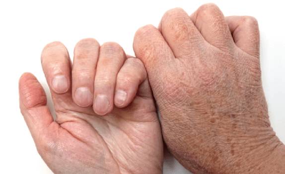 Проявление ксероза на руках