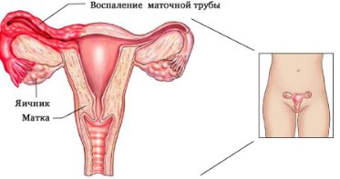 когда после месячных болит спина