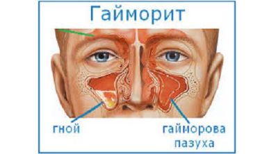 Болит спина может быть температура