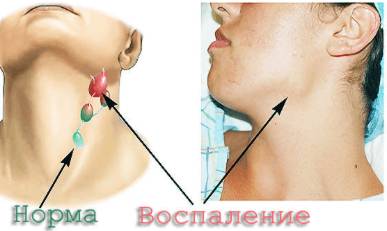 Болит спина может быть температура