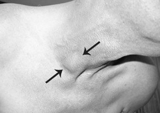 Тромбоз яремной вены