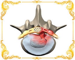 Боли после удаления грыжи диска