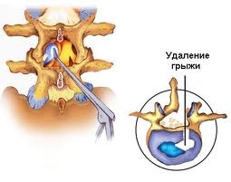Боли после операции удаления грыжи диска