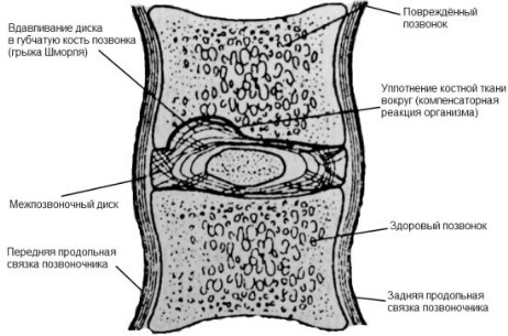 Боль после операции по удалению грыжи диска