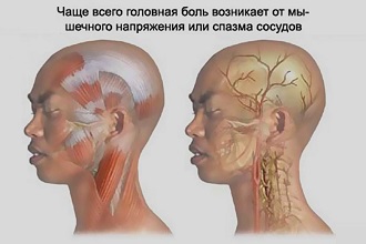 Головная боль от мышечного напряжения и спазма сосудов