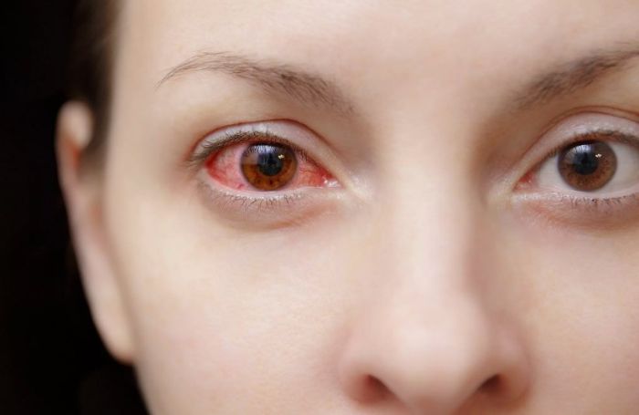 Покраснение склер при ОРВИ