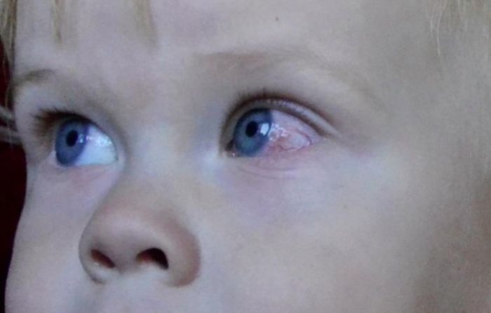 Покраснение склер у ребенка