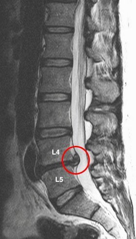 Сильно болит спина справа в середине