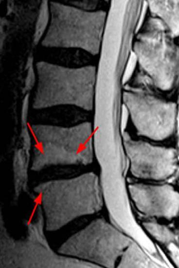 Поясничный остеохондроз на МРТ