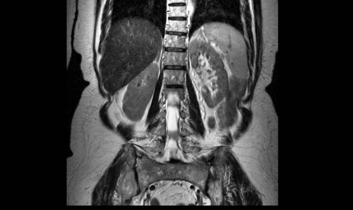 МРТ поясничного отдела позвоночника