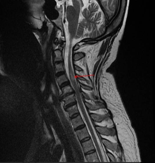 остеохондроз шейного отдела позвоночника на МРТ