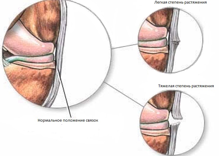 Состояние связок при растяжении