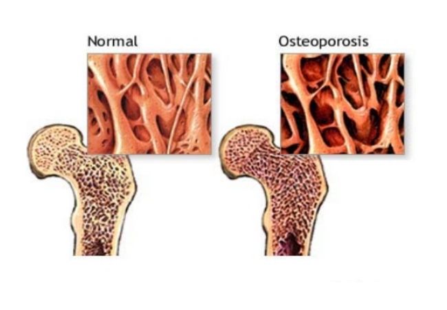 Остеопороз костей