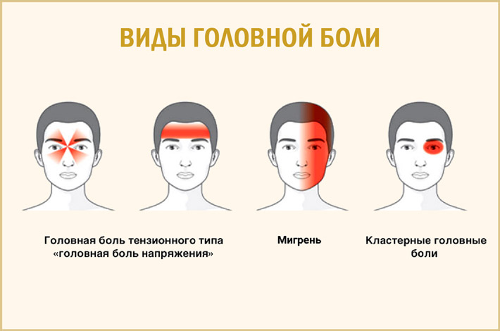 Типы головных болей Виды головной боли